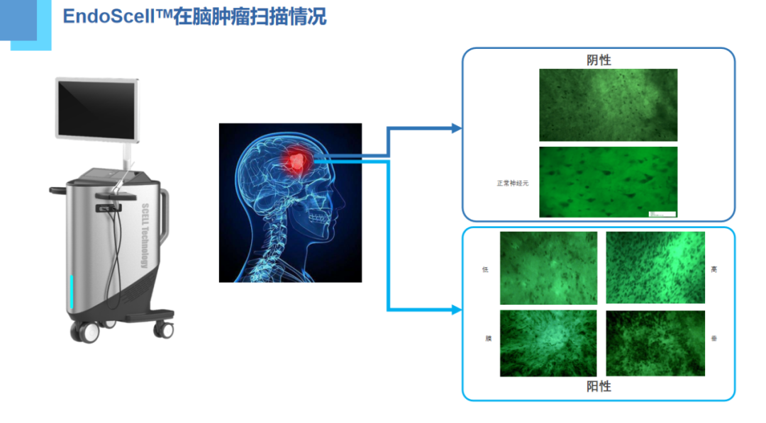 中國首個術中手持顯微鏡輔助膠質(zhì)母細胞瘤切除術的安全性有效性多中心研究項目方案討論會圓滿成功(圖5)